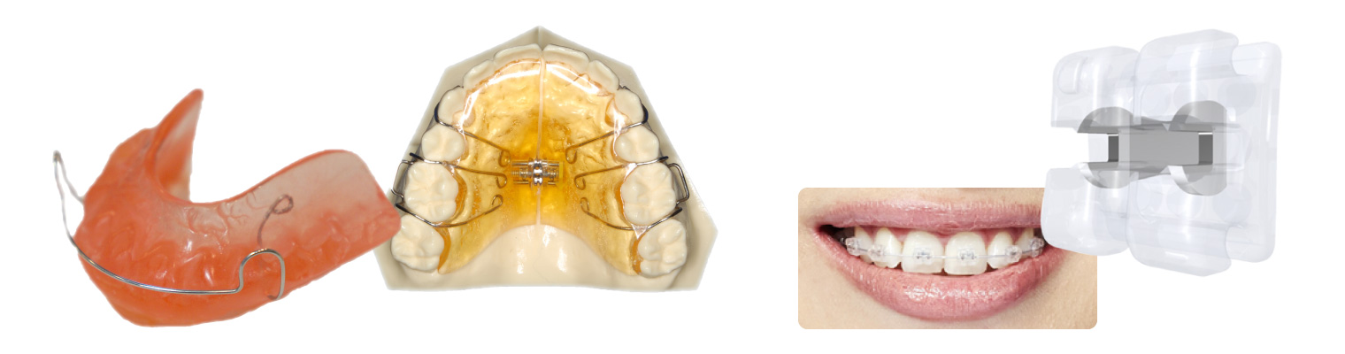 生えかわりの時期の矯正装置